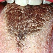 limba negru păros cauze, tratament blackening limba de ce negru