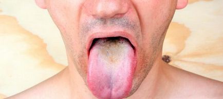 limba paroasa, senzație de părul de pe rădăcina limbii pe care un fel de boală, modul de a trata