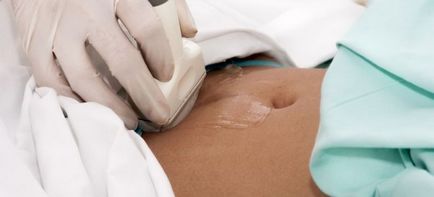 Inflamarea apendicelor la femei - simptome si tratament, diagnostic și complicații