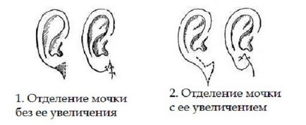 earlobes încarnate sau aderente - cauze, diagnostic si tratament