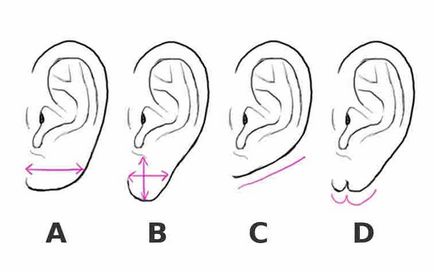 earlobes încarnate sau aderente - cauze, diagnostic si tratament