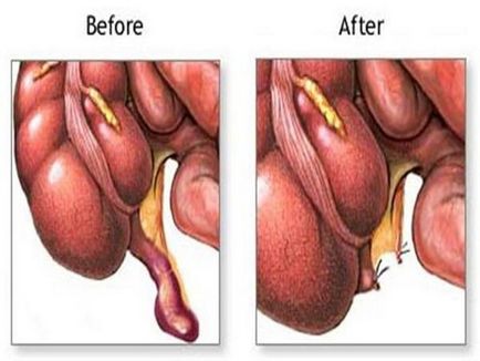 simptome apendicita cronica la femei, diagnostic, tratament