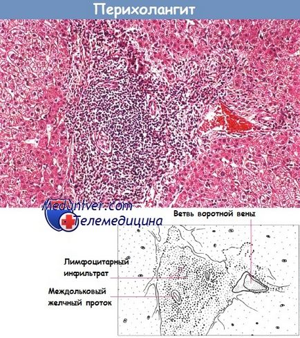 hepatită cronică