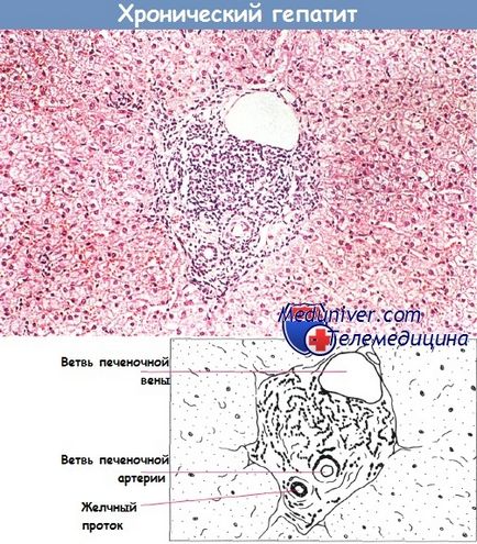 hepatită cronică