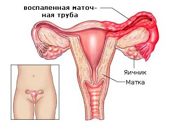 Cronice ooforitei - tratament, simptome, diagnostic (ooforita cronică) Cronică ooforitei - tratament, simptome, diagnostic
