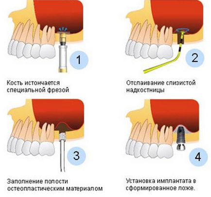 Înlocuirea tuturor dinților pe implanturi