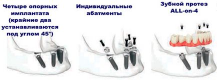 Înlocuirea tuturor dinților pe implanturi