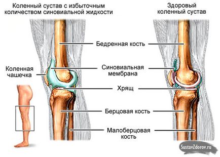 Lichidul din cauzele articulația genunchiului și de tratament, simptomele, diagnosticul