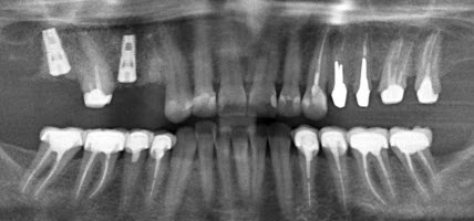 dentinari tubuli