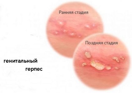 Pruritul inghinala simptomelor bărbați și tratament, provoacă o senzație de arsură în zona abdomenului