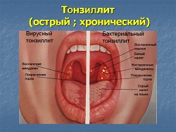 Tratamentul de antibiotice amigdalite Tratamentul de antibiotice amigdalite