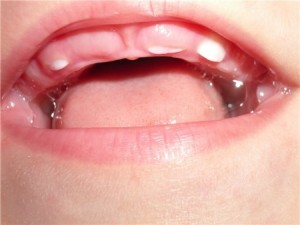 Ce să faci când urcatul dinții pot fi cel mai bine site-ul copilului despre stomatologie