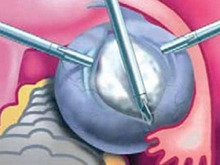 Care sunt efectele rezectia ovarelor și sarcina după o intervenție chirurgicală