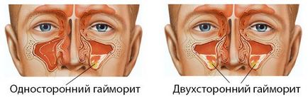 Tratamentul sinuzitei maxilare bilaterale