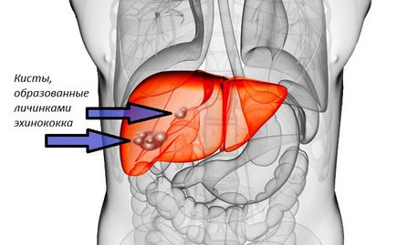 Diagnosticul bolii hidatice