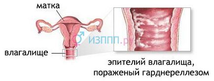 ADN-ul Gardnerella vaginalis l