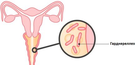 ADN-ul Gardnerella vaginalis l
