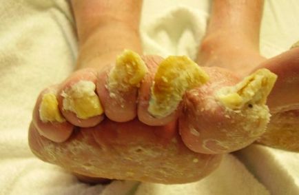 unghiile de la picioare Fungus fotografie, simptome, tratament
