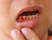 Dezintegrarea cura dinte