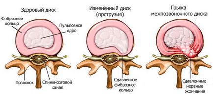 Ce se poate face cu o hernie la nivelul coloanei vertebrale