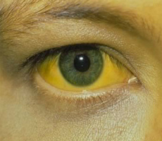 De ce albii galbene ale ochilor