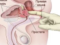 Prostatita la bărbați cauze