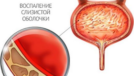 Cum de a trata inflamația vezicii urinare