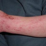 Alergia la simptome, tratament si detergent fotografie alergie manifestată la adulți