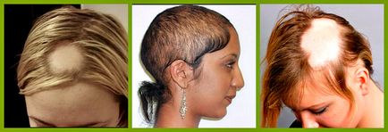 Alopecia în tipuri de femei, cauze chelie, remedii populare