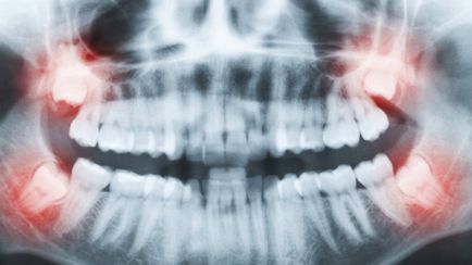Anestezice și ameliorarea durerii pentru tratarea dinților și a cavității orale