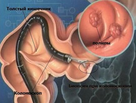 Biopsia a ceea ce este