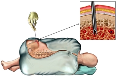 Biopsia - operațiuni și proceduri - descrierea procedurii, recuperarea