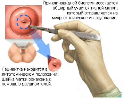 Biopsia de col uterin