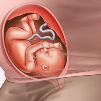 dimensiunea biparietal a capului fetale la 32 de săptămâni, 32 de săptămâni de sarcină