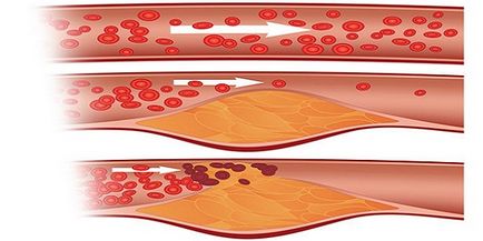 Boala cerebrovasculară, simptomele superioare și extremitatea inferioara, diagnostic si tratament