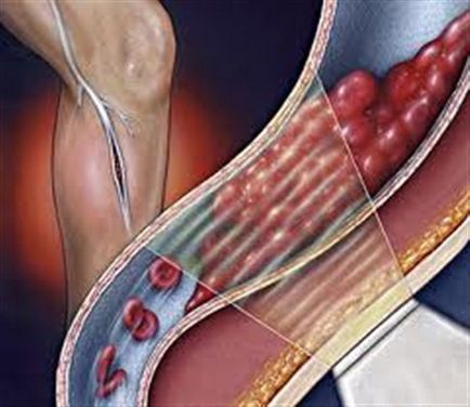 Boli ale vaselor de sânge ale simptomelor lor picioare si tratament
