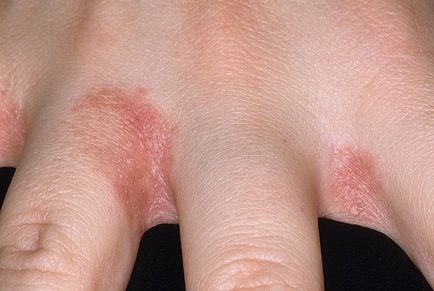 Pruritul între degetele de la picioare cauzele și tratamentul mâinilor