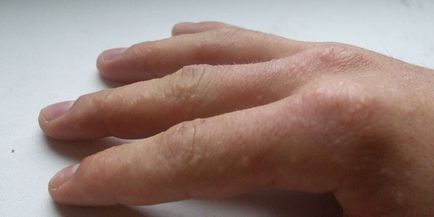 degetele Mîncărime - cauze de mâncărime și iritație, ca o trata la domiciliu