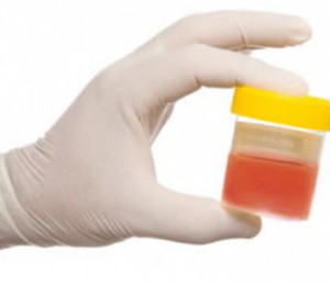 Ce se întâmplă dacă sângele detectat în urină de oameni care acest lucru poate fi și motivele care duc la boala