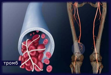 Ce este tromboza - simptome, tratament, prevenire