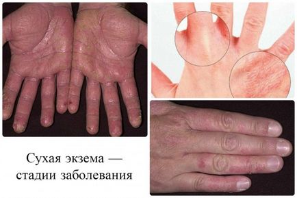 Cuhaya eczeme pe mâini decât vindecarea - detalii