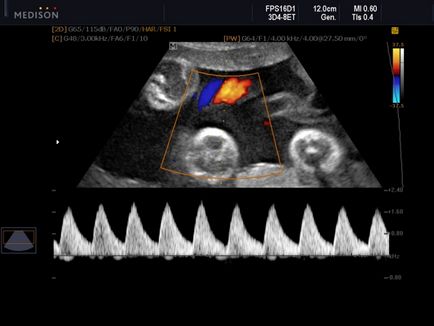 Parametrii Doppler fetal de decriptare în timpul sarcinii, standardele de ultrasunete