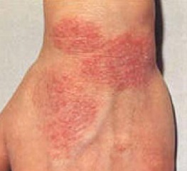 Eczeme fotografie, simptome și tratament, etapa inițială