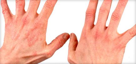 Eczeme pe mâini decât pentru a vindeca, cele mai bune mijloace (unguente, creme, tablete, injecții și rețete tradiționale)