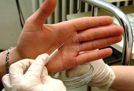 Eczeme pe mâini decât vindecarea, medicamente, comentarii