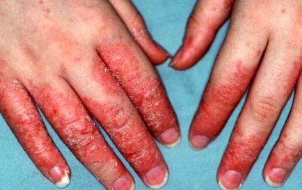 Eczeme pe mâini decât vindecarea, medicamente, comentarii