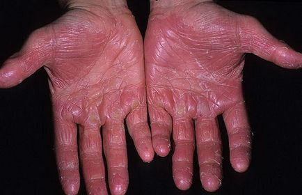 Eczeme pe maini (fotografie) - decât pentru tratarea bolii