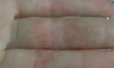 Eczema pe imaginea de tratament mâini, etapa inițială de