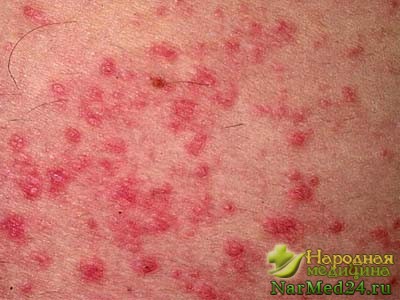 Cauzele principale eczemă, simptome și tratament de atac folk