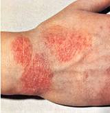 Eczema - cauze, simptome si remedii populare eczeme tratament